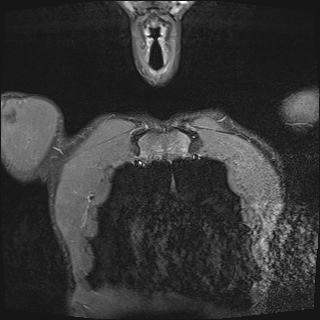 File:Bilateral spinoglenoid notch ganglion cysts (Radiopaedia 29577-30082 Coronal STIR 1).jpg
