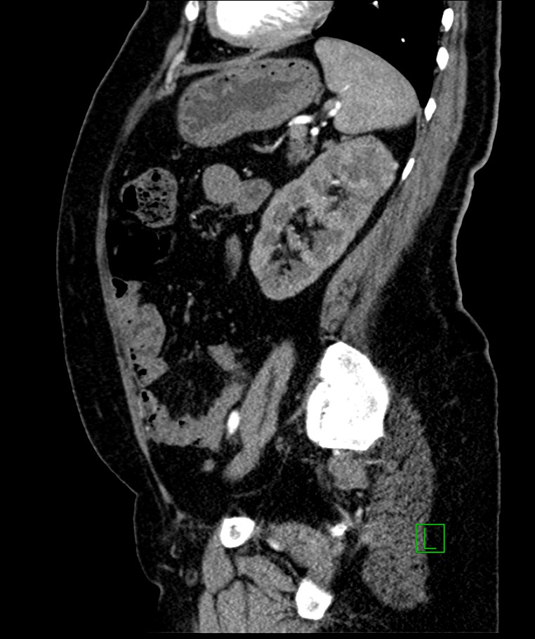 Bilateral sporadic synchronous clear cell renal cell carcinoma (Radiopaedia 85035-100575 E 43).jpg