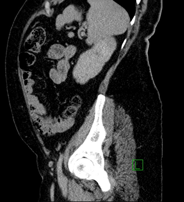Bilateral sporadic synchronous clear cell renal cell carcinoma (Radiopaedia 85035-100575 J 5).jpg