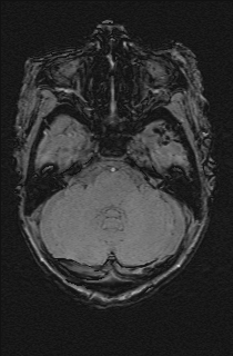 Bilateral subdural hemorrhage and parietal skull fracture (Radiopaedia 26058-26190 Axial SWI 15).png
