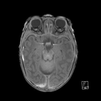 File:Bilateral subdural hemorrhage and parietal skull fracture (Radiopaedia 26058-26190 Axial T1 19).png