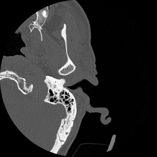 Bilateral temporal bone fractures (Radiopaedia 29482-29970 D 28).jpg