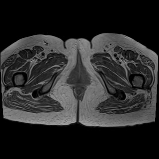 Bilateral tubo-ovarian abscesses (Radiopaedia 58635-65829 Axial T1 C+ 52).jpg