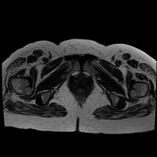 Bilateral tubo-ovarian abscesses (Radiopaedia 58635-65829 Axial T2 44).jpg