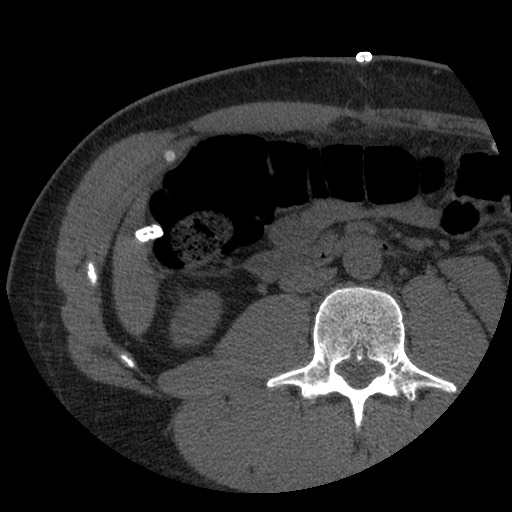 Bile leak from liver traumatic laceration (Radiopaedia 63463-72077 Axial Biliscopin 78).jpg
