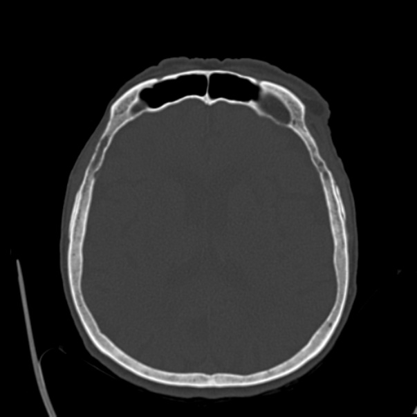 Biparietal osteodystrophy (Radiopaedia 46109-50463 bone window 39).jpg