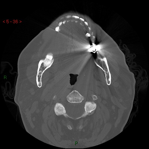 Bisphosphonate-related osteonecrosis of the jaw (Radiopaedia 54147-60329 Axial bone window 30).jpg