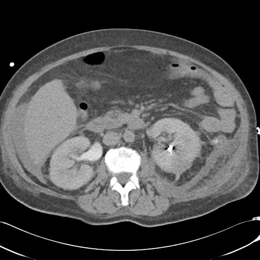 Bladder rupture post renal biopsy (Radiopaedia 30863-31572 Axial non-contrast 39).jpg