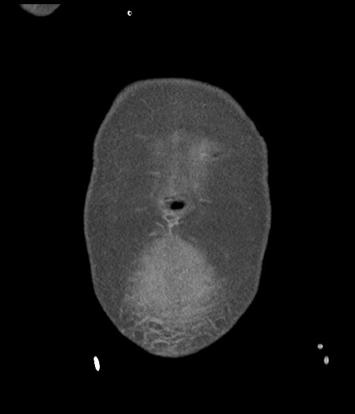 Bladder rupture post renal biopsy (Radiopaedia 30863-31572 Coronal non-contrast 7).jpg