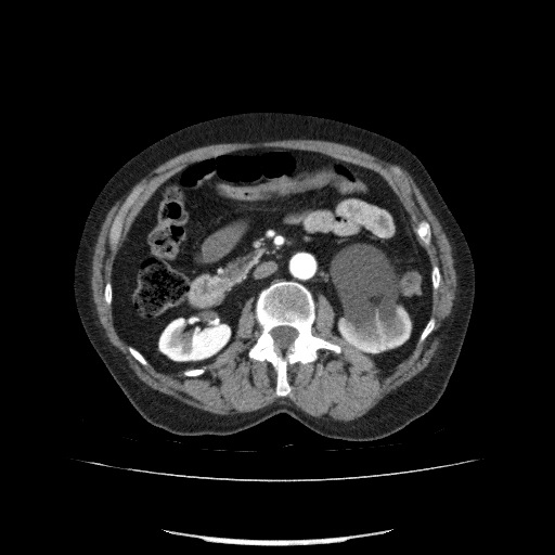 File:Bladder tumor detected on trauma CT (Radiopaedia 51809-57609 A 108).jpg