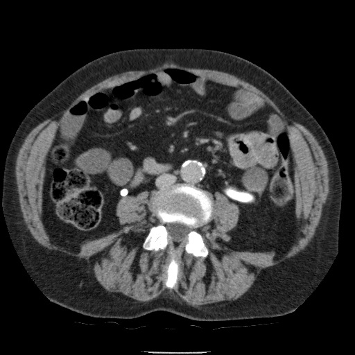 Bladder tumor detected on trauma CT (Radiopaedia 51809-57609 C 76).jpg