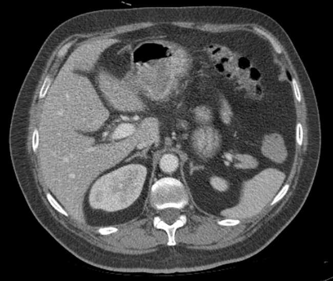 Bleeding duodenal ulcer and adenomyomatosis of gallbladder (Radiopaedia 61834-69861 A 30).jpg