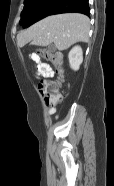 Bleeding duodenal ulcer and adenomyomatosis of gallbladder (Radiopaedia 61834-69861 C 20).jpg