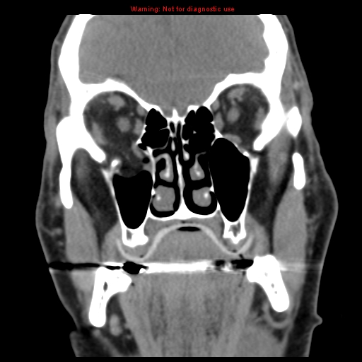 File:Blowout fracture with inferior rectus entrapment (Radiopaedia 12418-12673 Coronal non-contrast 13).jpg