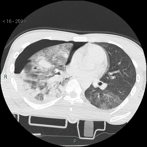 Blunt chest trauma (Swiss cheese sign) (Radiopaedia 38519-40618 Axial lung window 39).jpg