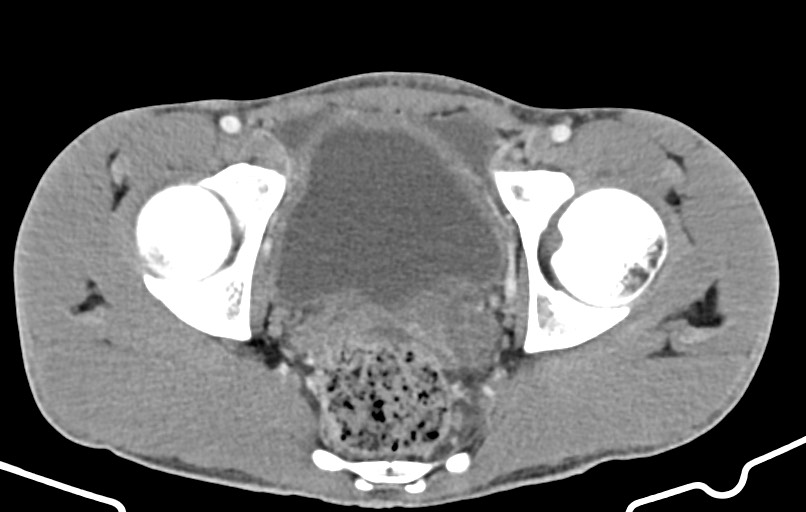 Blunt injury to the small bowel (Radiopaedia 74953-85987 A 179).jpg