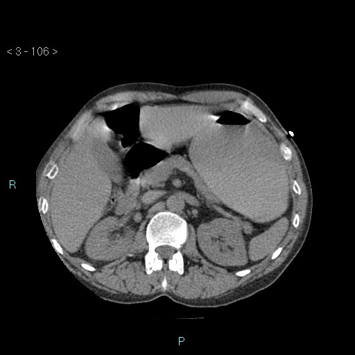 Boerhaave syndrome (Radiopaedia 27683-27897 oral contrast 106).jpg
