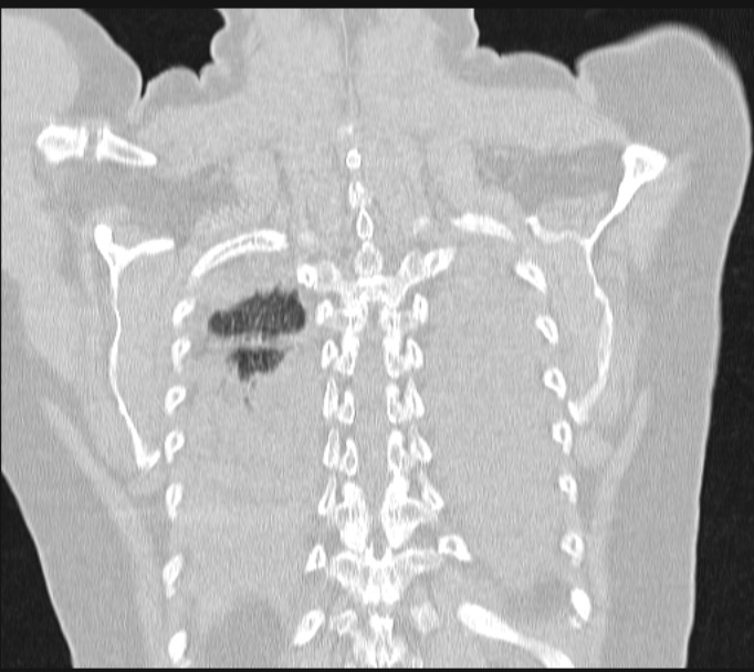 Boerhaave syndrome (Radiopaedia 45644-49799 Coronal lung window 59).jpg