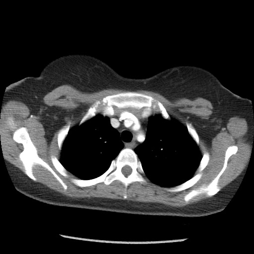 File:Borderline mucinous tumor (ovary) (Radiopaedia 78228-90808 A 12).jpg