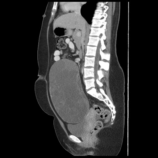 File:Borderline mucinous tumor (ovary) (Radiopaedia 78228-90808 B 35).jpg