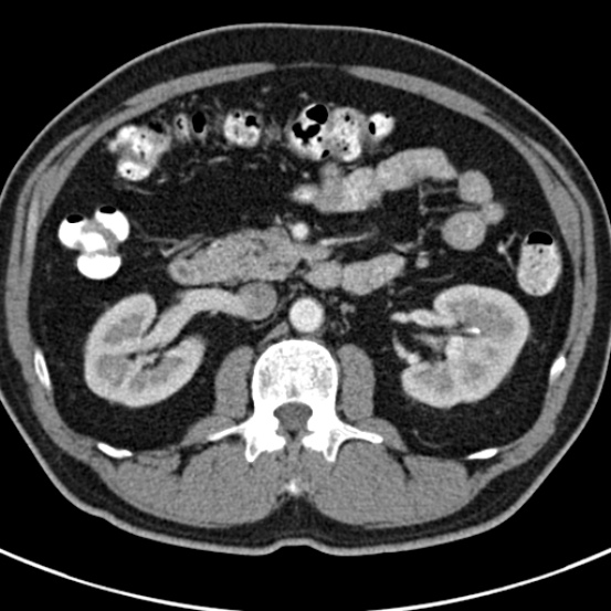 File:Bosniak cyst - type IV (Radiopaedia 23525-23627 renal cortical phase 25).jpg