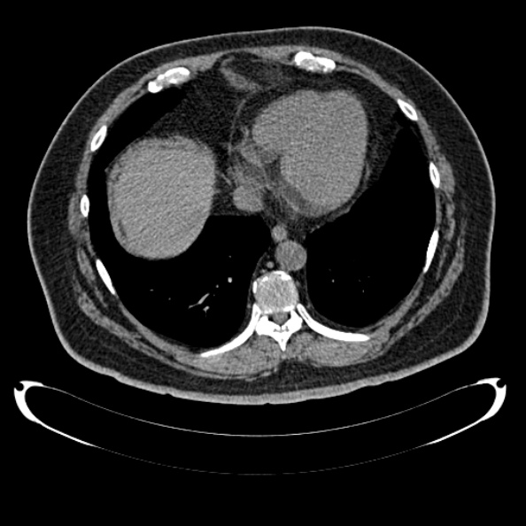 Bosniak renal cyst - type IV (Radiopaedia 24244-24518 Axial non-contrast 19).jpg