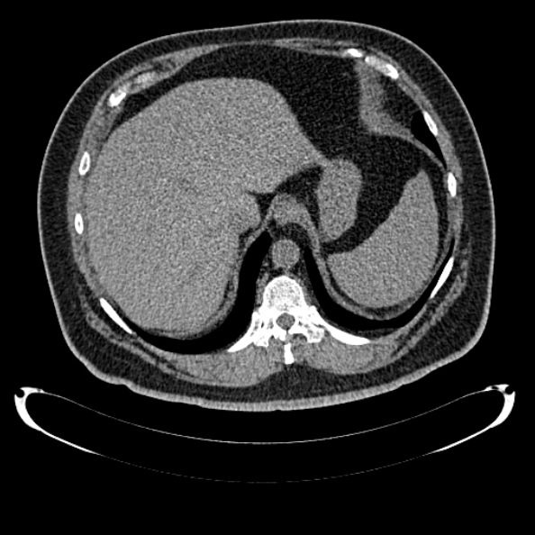 Bosniak renal cyst - type IV (Radiopaedia 24244-24518 Axial non-contrast 69).jpg