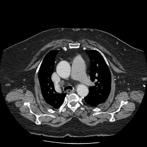 Bovine aortic arch - right internal mammary vein drains into the superior vena cava (Radiopaedia 63296-71875 A 48).jpg