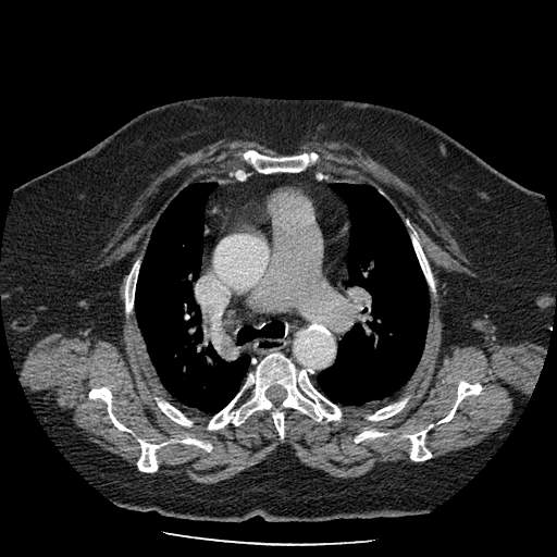 Bovine aortic arch - right internal mammary vein drains into the superior vena cava (Radiopaedia 63296-71875 A 54).jpg