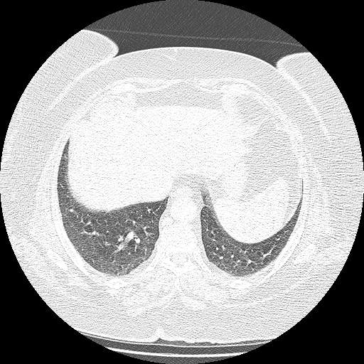 Bovine aortic arch - right internal mammary vein drains into the superior vena cava (Radiopaedia 63296-71875 Axial lung window 129).jpg