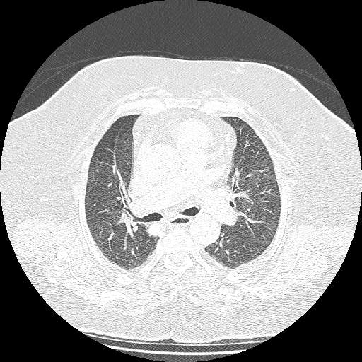 Bovine aortic arch - right internal mammary vein drains into the superior vena cava (Radiopaedia 63296-71875 Axial lung window 64).jpg