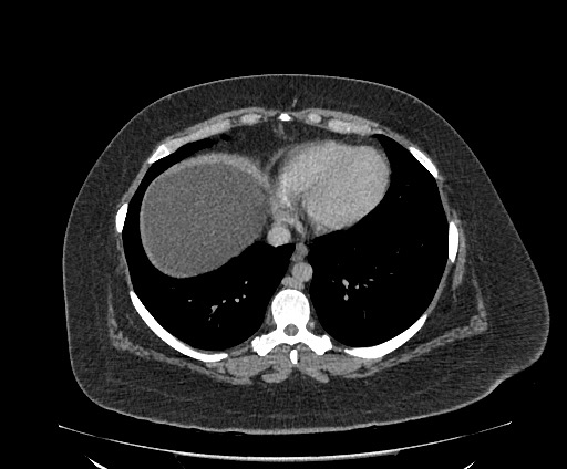 Bowel and splenic infarcts in acute lymphocytic leukemia (Radiopaedia 61055-68913 A 15).jpg