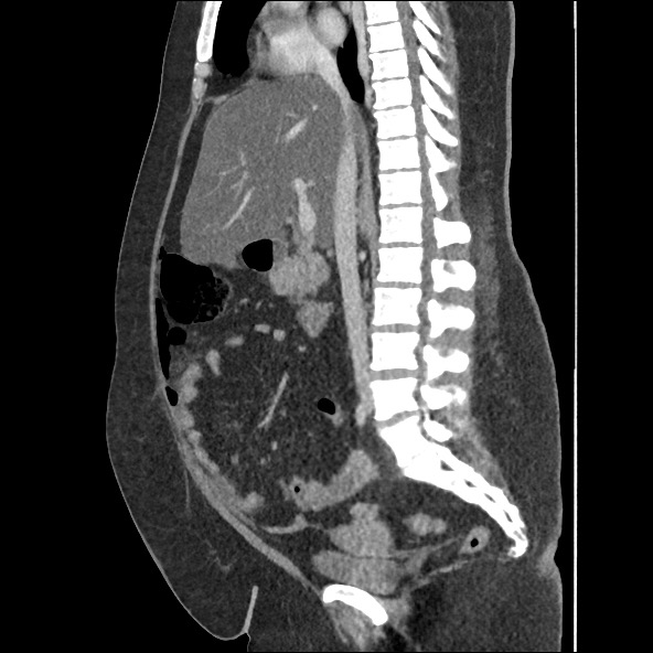 Bowel and splenic infarcts in acute lymphocytic leukemia (Radiopaedia 61055-68915 C 38).jpg