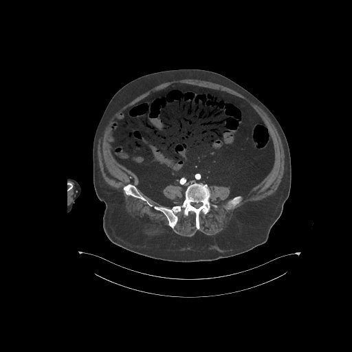 File:Bowel ischemia secondary to SMA occlusion with extensive portomesenteric venous gas (Radiopaedia 54656-60871 A 22).jpg