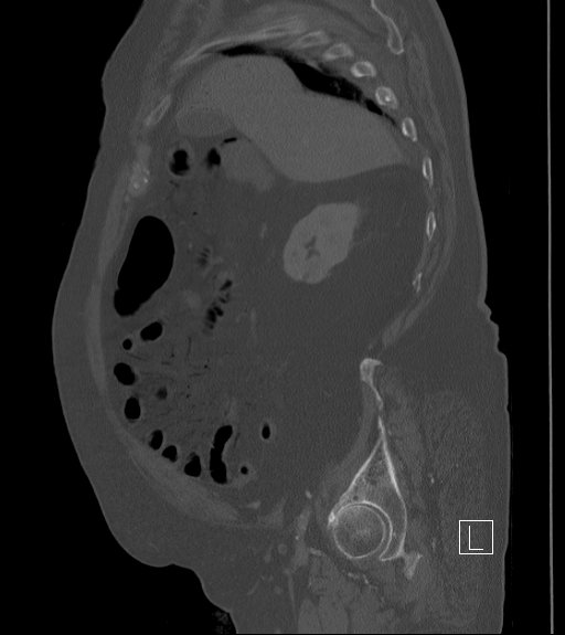 Bowel ischemia secondary to SMA occlusion with extensive portomesenteric venous gas (Radiopaedia 54656-60871 Sagittal bone window 85).jpg