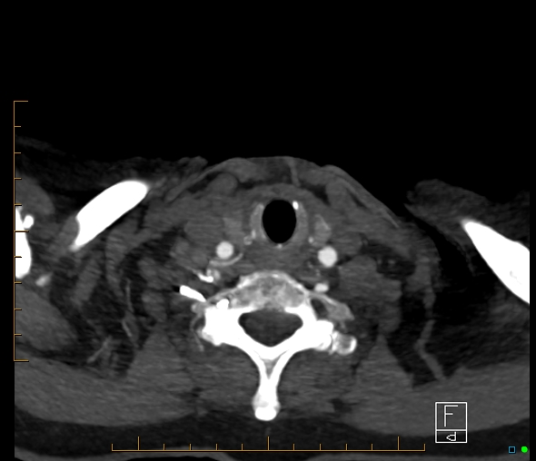 Brachiocephalic trunk stenosis (Radiopaedia 87242-103519 A 114).jpg
