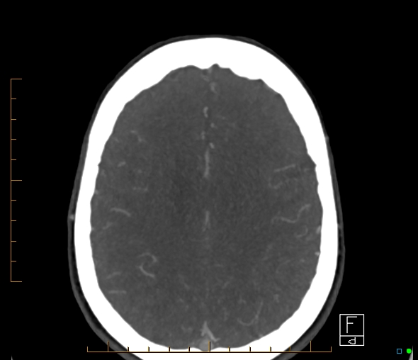 Brachiocephalic trunk stenosis (Radiopaedia 87242-103519 A 21).jpg