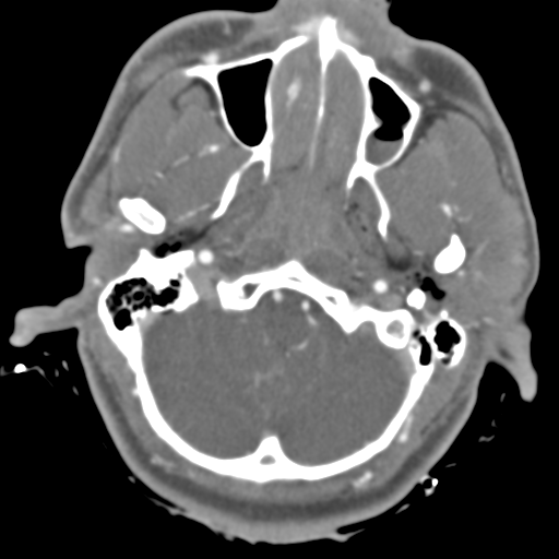 Brain contusions, internal carotid artery dissection and base of skull fracture (Radiopaedia 34089-35339 D 47).png
