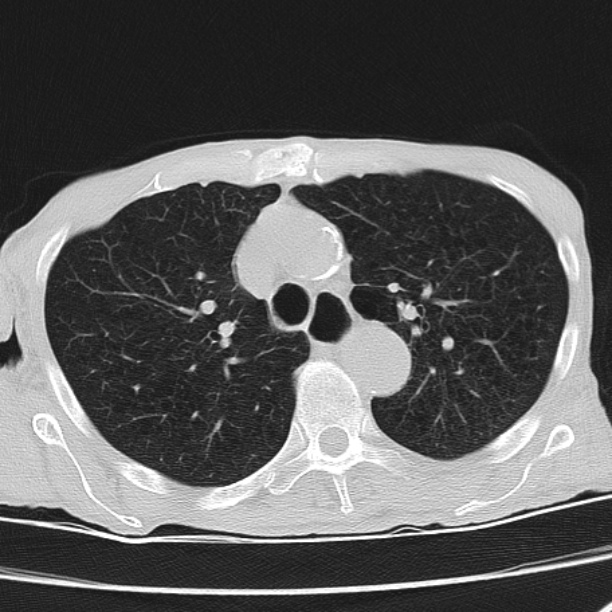 Brain metastases from lung cancer (Radiopaedia 27849-28093 Axial lung window 22).jpg