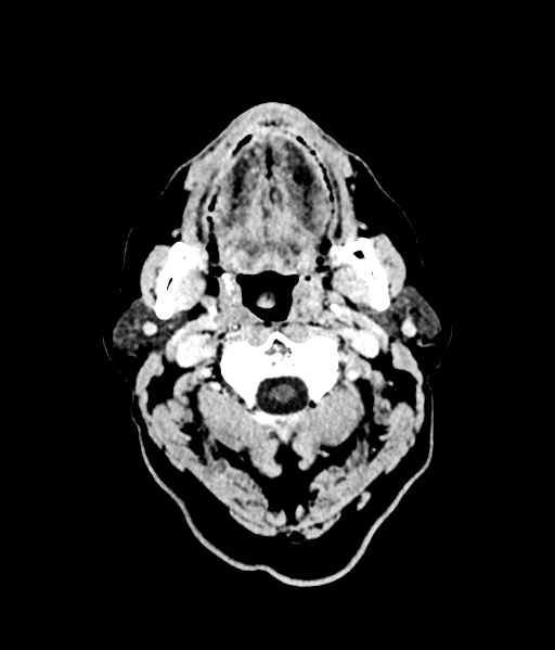 Brain metastasis (large cystic mass) (Radiopaedia 47497-52106 Axial C+ 3).png
