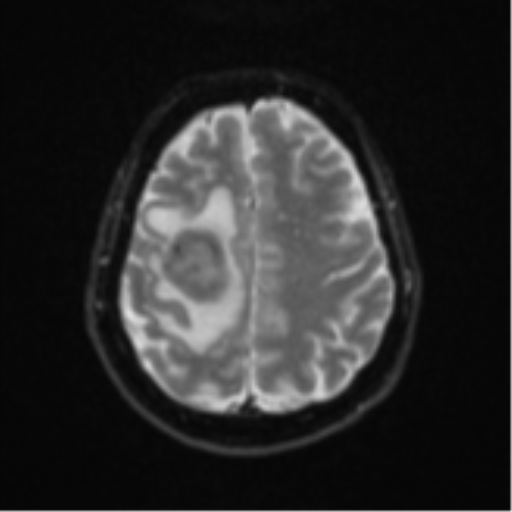 Brain metastasis (sarcoma) (Radiopaedia 47576-52209 Axial DWI 20).png