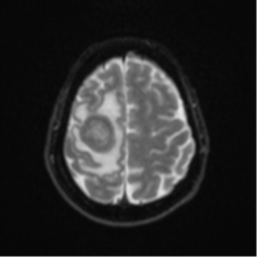 File:Brain metastasis (sarcoma) (Radiopaedia 47576-52209 Axial DWI 21).png