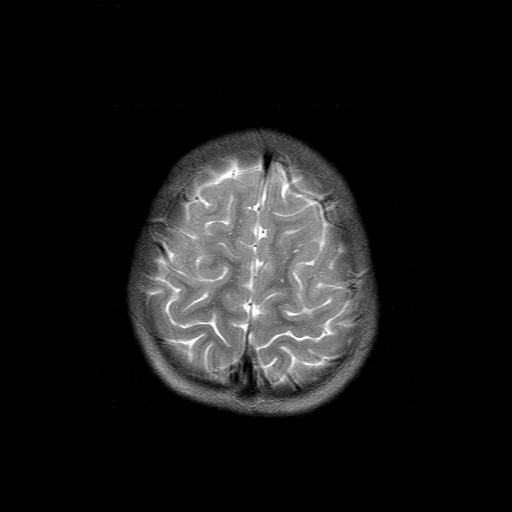 File:Brainstem ganglioglioma (Radiopaedia 10763-11224 Axial T2 3).jpg