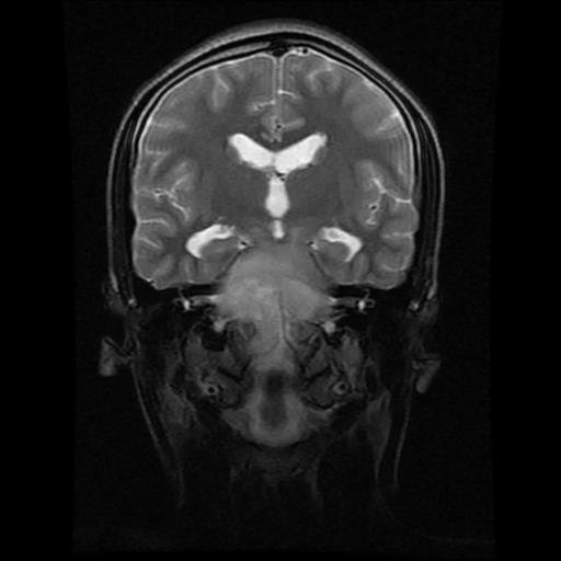 File:Brainstem glioma (Radiopaedia 30923-31624 Coronal T2 10).jpg