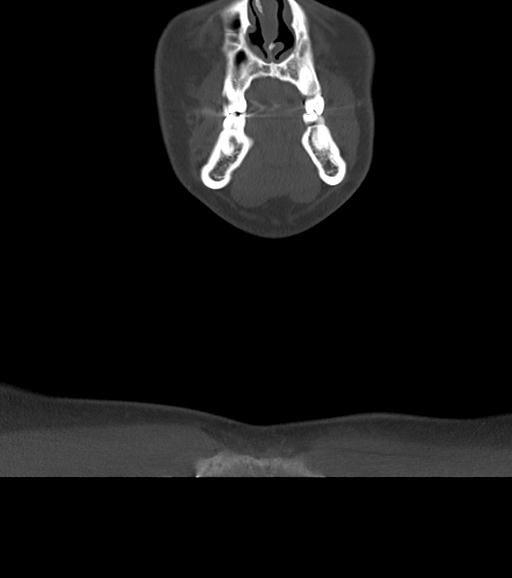 Branchial cleft cyst (Radiopaedia 31167-31875 Coronal bone window 14).jpg