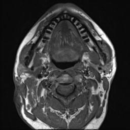 File:Branchial cleft cyst (Radiopaedia 31167-31876 Axial T1 16).jpg