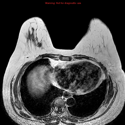 File:Breast carcinoma (multicentric multifocal in mammary Paget disease) (Radiopaedia 50966-56512 Axial T1 2).jpg