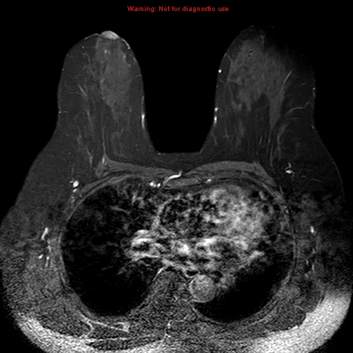 File:Breast carcinoma (multicentric multifocal in mammary Paget disease) (Radiopaedia 50966-56512 Axial T1 C+ fat sat 9).jpg