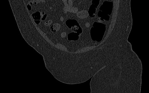 Breast carcinoma with pathological hip fracture (Radiopaedia 60314-67993 Coronal bone window 39).jpg
