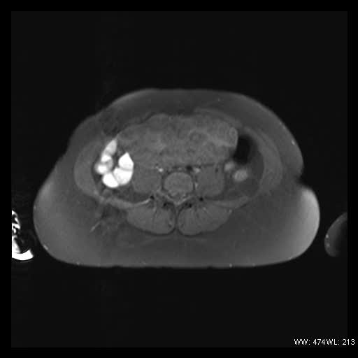 File:Broad ligament fibroid (Radiopaedia 49135-54241 Axial T1 fat sat 4).jpg